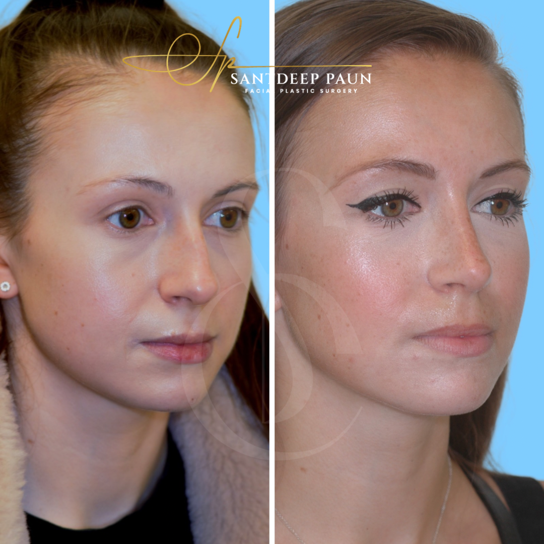 Rhinoplasty London | Mr Santdeep Paun FRCS | 4.9★ Rated